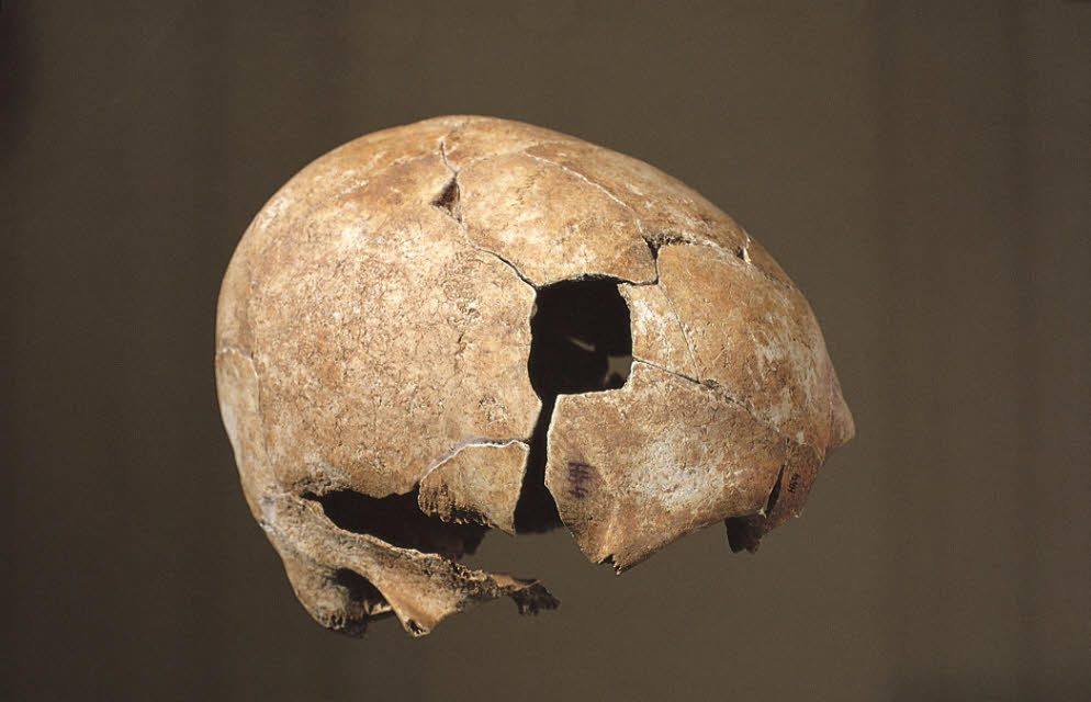 Schädel eines ca. 40-jährigen Mannes aus der Jungsteinzeit mit unverheiltem Lochdefekt infolge stumpfer Gewalt in der rechten Schläfenregion, © Landesamt für Denkmalpflege im RPS