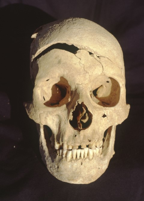 Schädel eines ca. 40- bis 50-jährigen Mannes aus dem frühen Mittelalter mit unverheilter Hiebverletzung im Stirnbereich, © Landesamt für Denkmalpflege im RPS